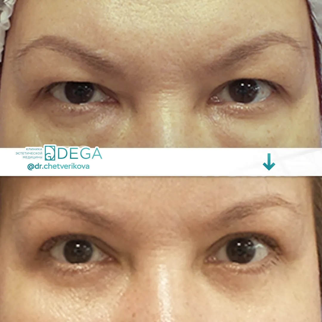 Четверикова МА - Блефаропластика №29