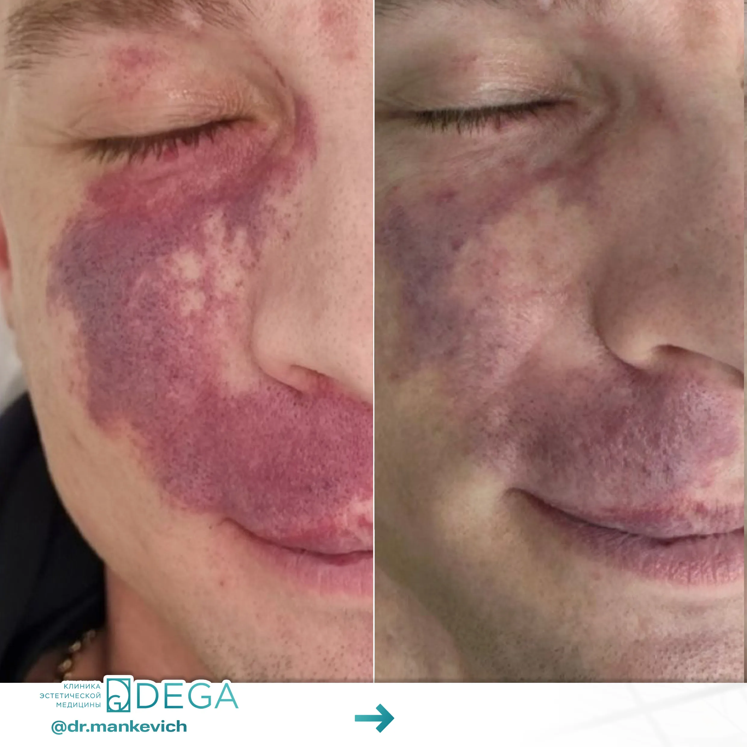 Манкевич Екатерина Петровна - Лазерное омоложение №1