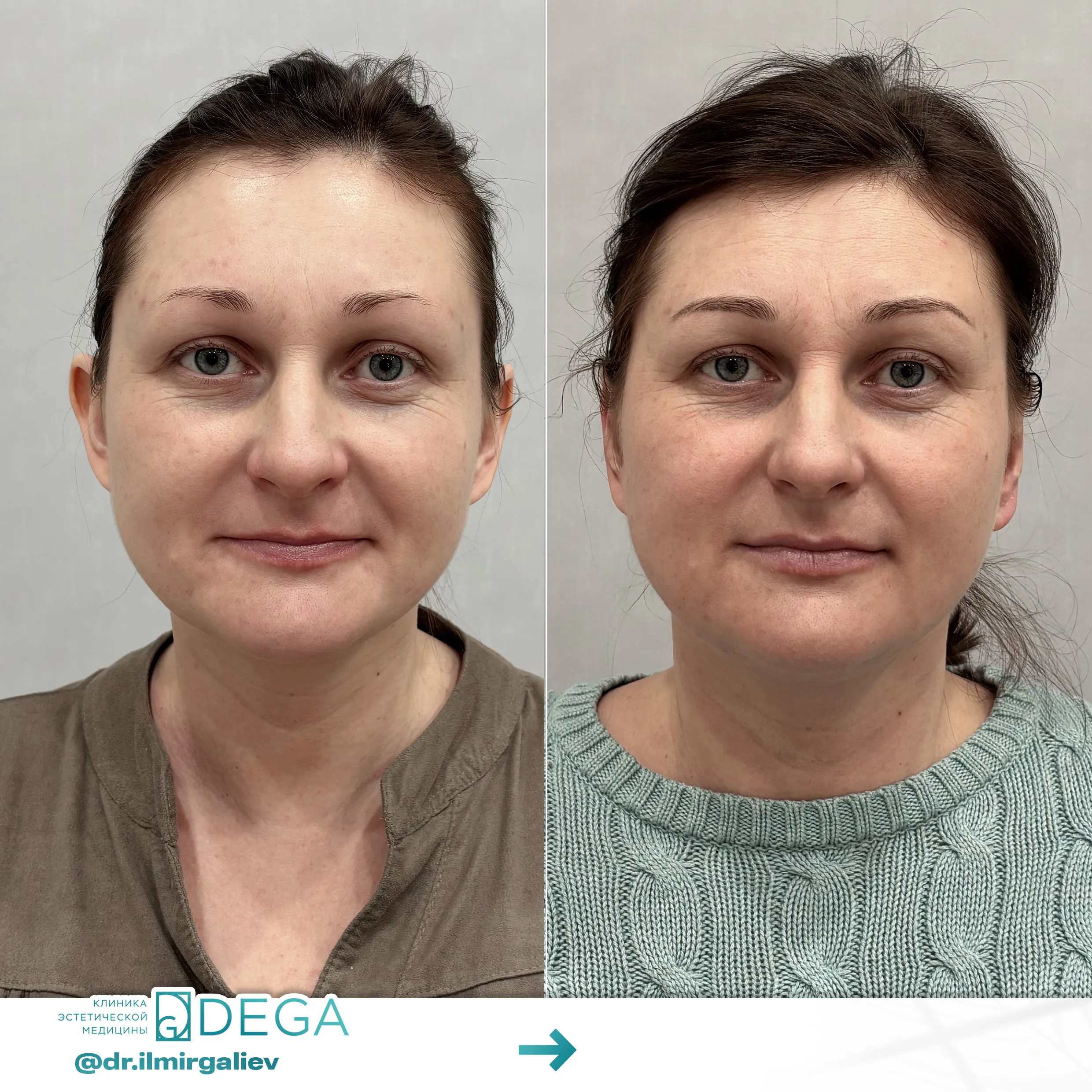 Галиев Ильмир Амирович №19 Отопластика (пластика ушей)