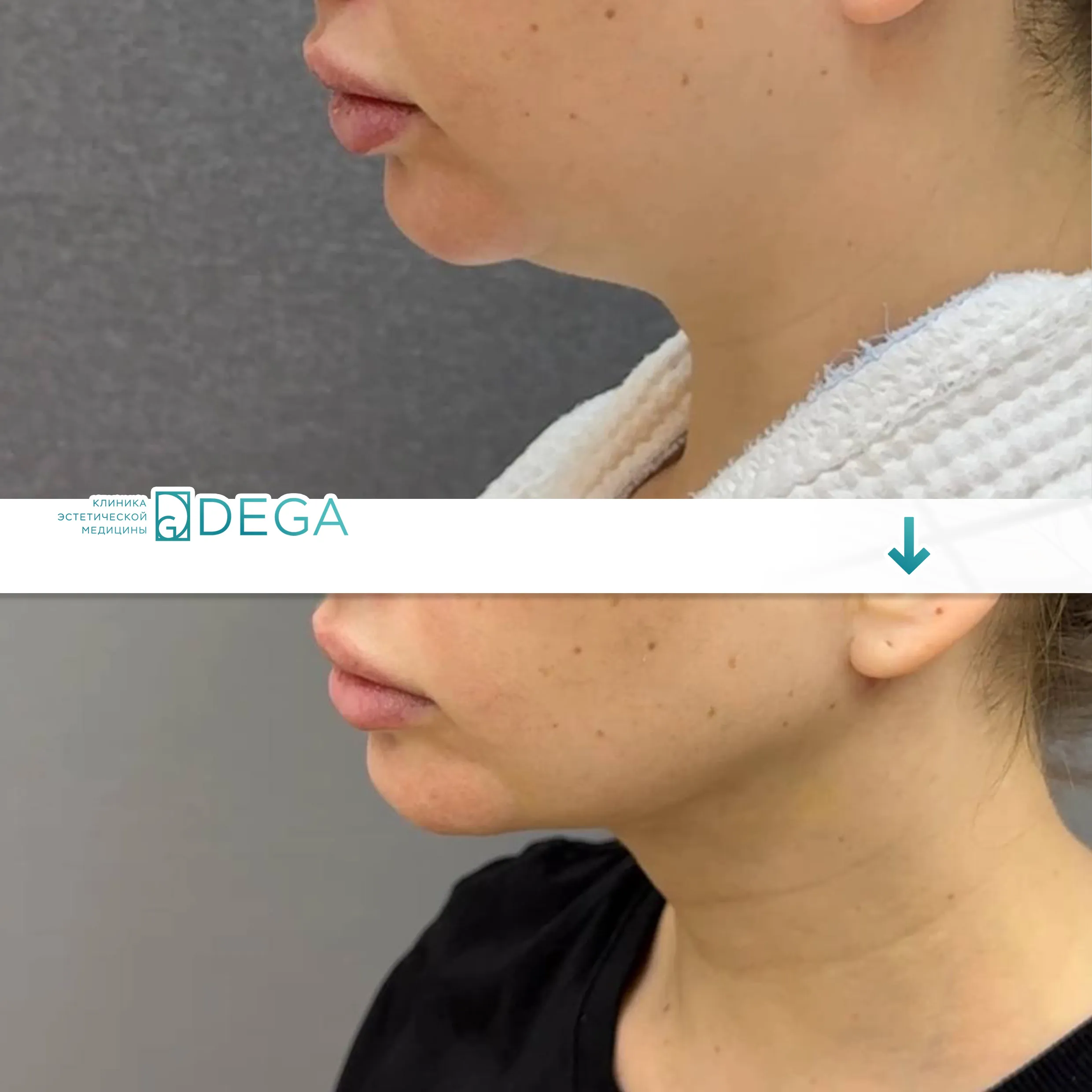 Шорников Евгений Сергеевич №17.1 Пластика лица Липосакция лица Липосакция подбородка