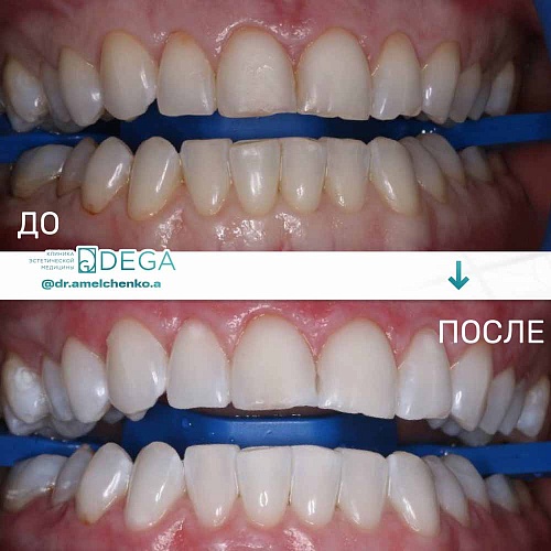 Профессиональное отбеливание зубов с использованием системы ZOOM4